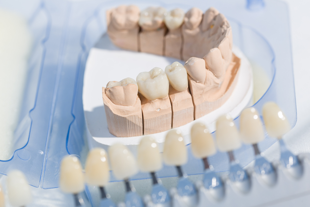 What Is Dental Bleaching?