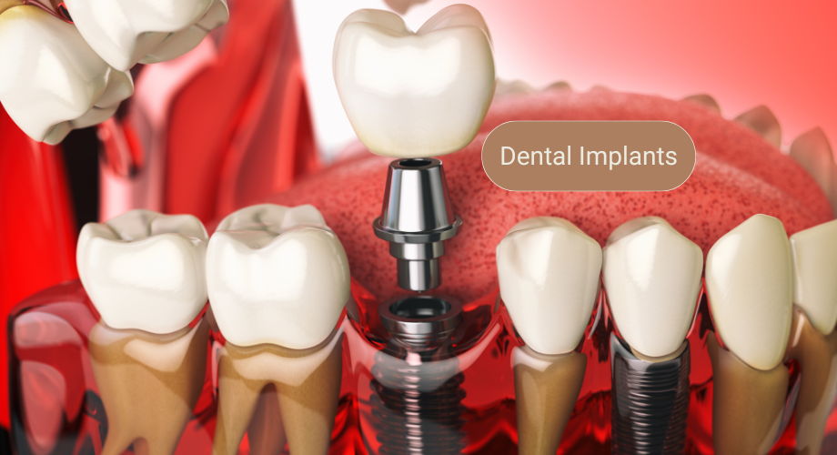 The Complete Guide to the Cost of Full Mouth Dental Implants